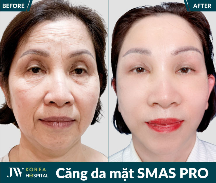 Hình ảnh của khách hàng trước và sau căng da mặt Smas Pro tại bệnh viện JW