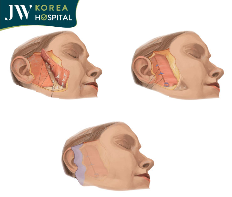 Hình ảnh mô phỏng lớp SMAS lớp cân cơ nông nâng đỡ cấu trúc gương mặt