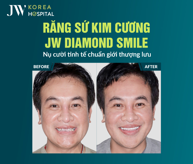 Răng sứ JW Diamond Smile hạn chế bám màu, duy trì độ trắng sáng theo thời gian sử dụng.