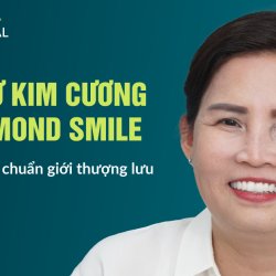 Răng sứ kim cương JW Diamond Smile – Nụ cười đẹp tinh tế chuẩn giới thượng lưu