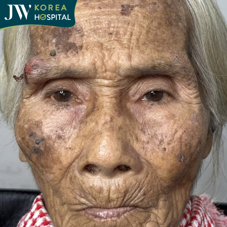 Cụ bà 90 tuổi mang khối u chân mày lở loét, chảy máu suốt gần 2 năm