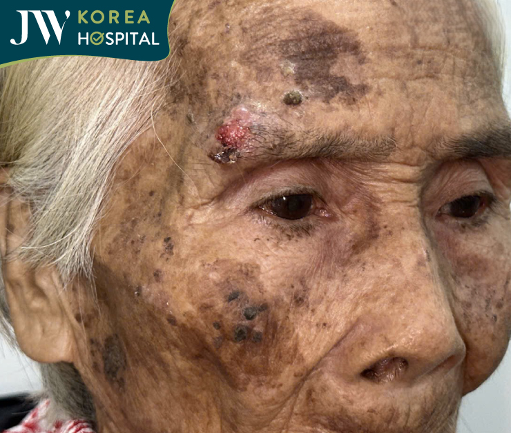 Khối u chân mày lở loét và chảy máu liên tục khiến cụ bà 90 tuổi sống trong đau đớn suốt gần 2 năm