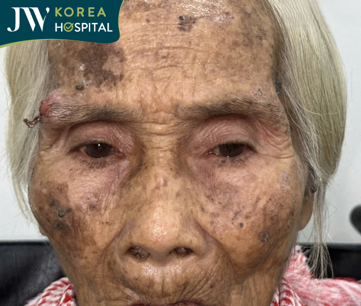 cụ bà mang khối u chân mày lở loét và chảy máu đến cầu cứu bác sĩ Tú Dung và bệnh viện JW