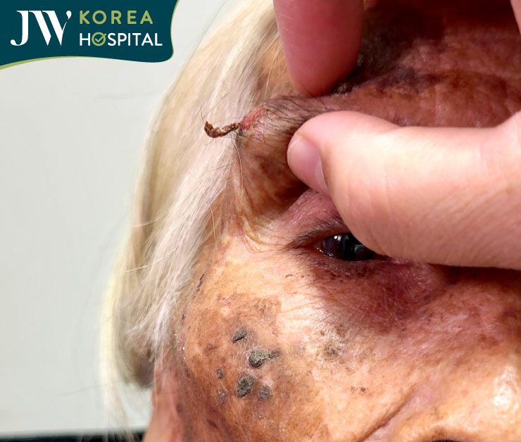 Khối u từ hạt đậu nhỏ dần phát triển lớn theo thời gian và lở loét, chảy máu liên tục 