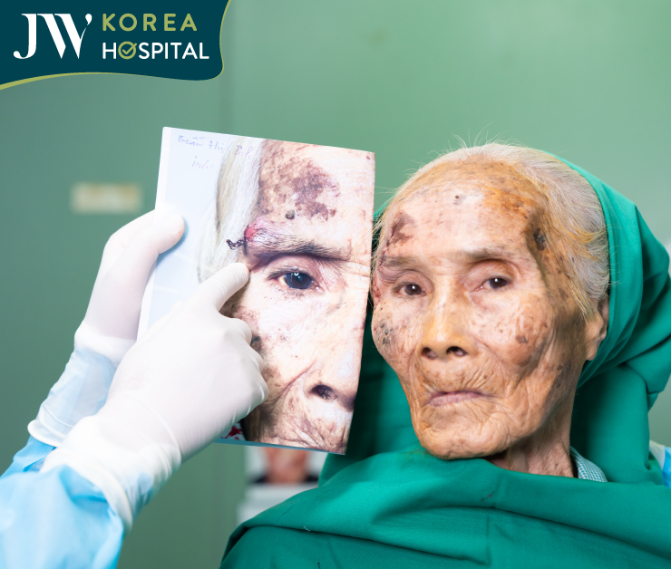 Hình ảnh trước và sau của cụ bà 90 tuổi bị suy tim khi ca phẫu thuật cắt bỏ u kết thúc 