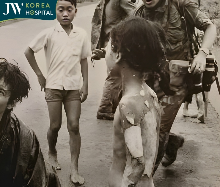 Em bé Napalm bị phỏng toàn thân 