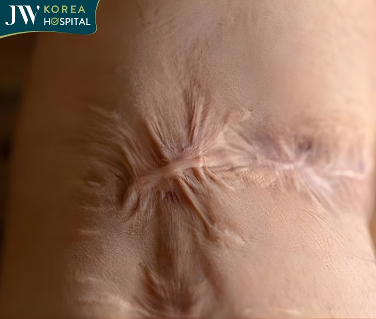 Sẹo do bỏng để lại 