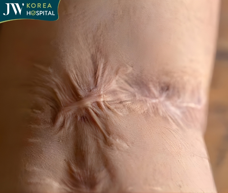 Vết sẹo bòng do bom napalm để lại cho nạn nhân