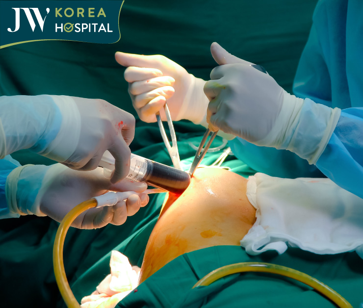 Bác sĩ Tú Dung và ê-kíp JW hút hơn 1 lít dịch mủ và silicone công nghiệp từ túi độn mông vỡ nát của bệnh nhân