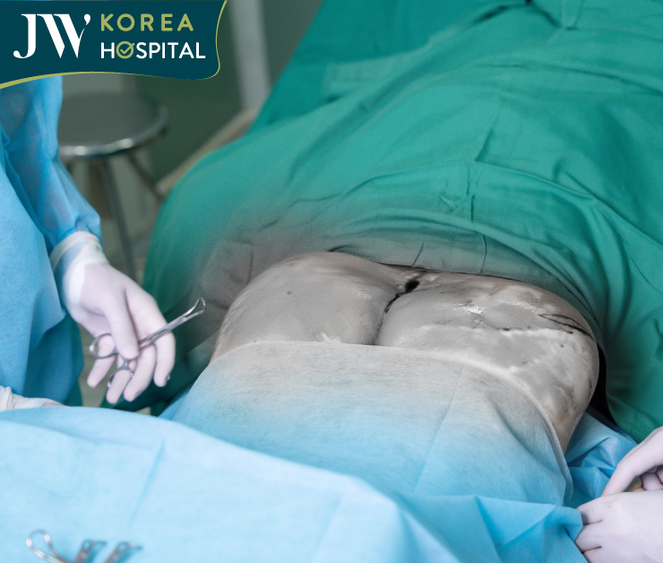 Mông bệnh nhân biến dạng, sưng tấy, lệch hẳn sau 4 năm đặt túi độn mông tại 1 cơ sở thẩm mỹ chui