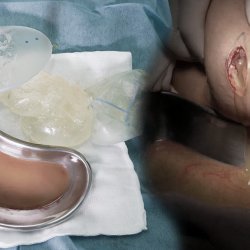 Vỡ túi độn mông, silicone tuôn trào, người phụ nữ được Bệnh viện JW cấp cứu khẩn