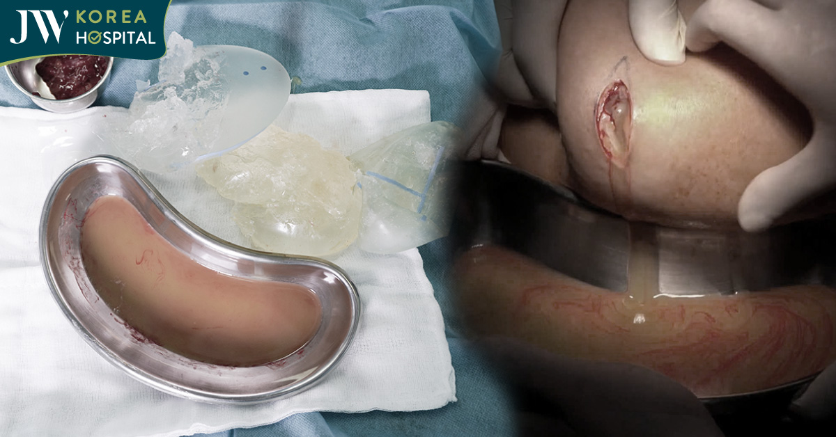 Bệnh viện JW cấp cứu khẩn cấp ca vỡ túi độn mông, silicone tuôn trào như thác của một nữ bệnh nhân 40 tuổi