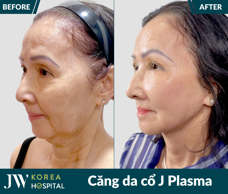 Căng da cổ không phẫu thuật tại bệnh viện JW với công nghệ J Plasma