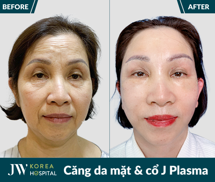 Căng da mặt và cổ J Plasma