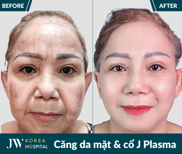 Căng da mặt và cổ J Plasma
