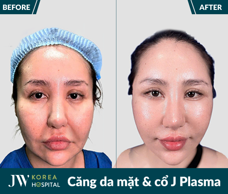 Căng da mặt và cổ J Plasma