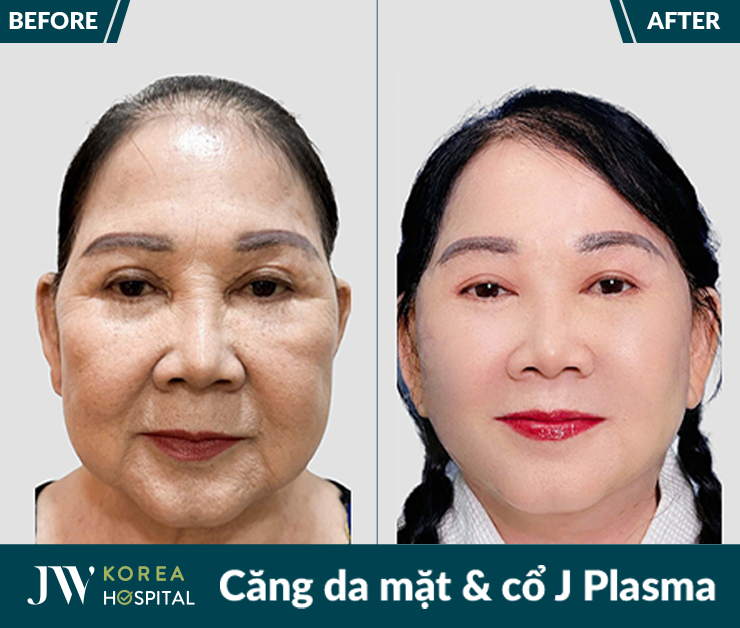 Căng da mặt và cổ J Plasma