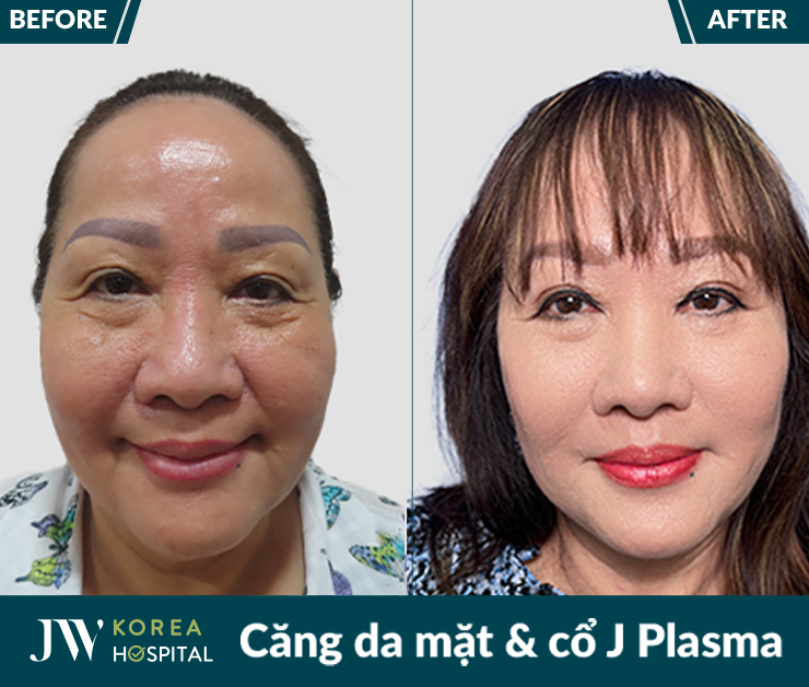 Căng da mặt và cổ J Plasma