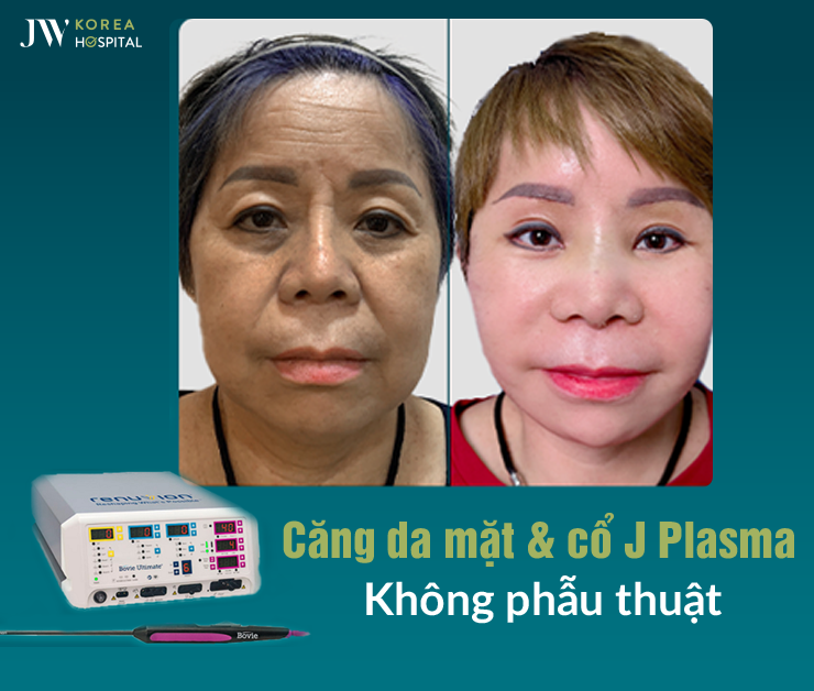 Công nghệ J Plasma