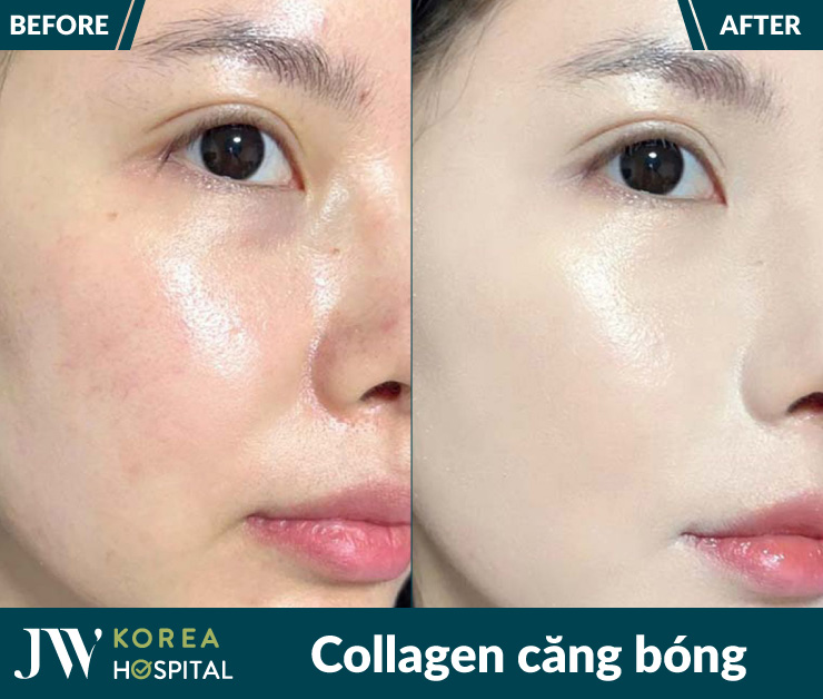 Da căng bóng, mịn màng với Meso Collagen tại Bệnh viện JW