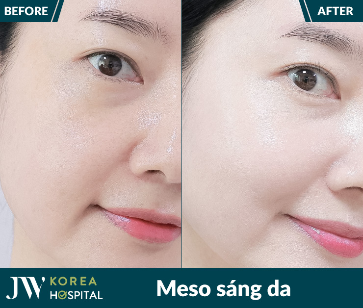 Da sáng đều màu chỉ sau 1 liệu trình Meso chuẩn Hàn tại bệnh viện JW