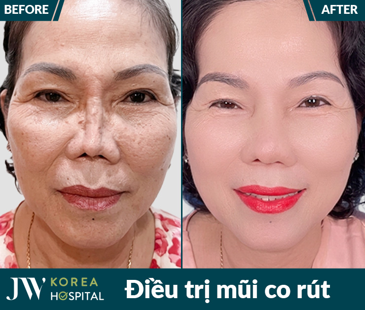 Nhiều bệnh nhân đã lấy lại dáng mũi tự nhiên ngoạn mục sau bị biến chứng nặng do thẩm mỹ lỗi