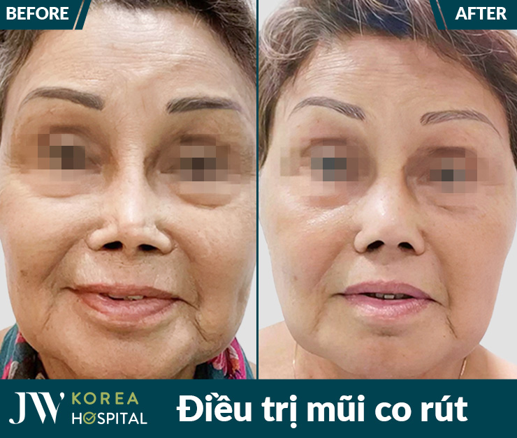 Điều trị mũi co rút, giúp lấy lại dáng mũi tự nhiên sau biến chứng tại bệnh viện JW