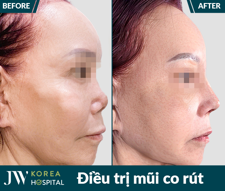 Nhiều trường hợp bị mũi co rút, biến dạng sau nâng mũi được điều trị thành công tại Bệnh viện JW