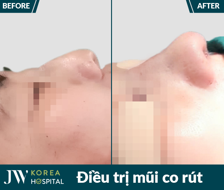 Bác sĩ Tú Dung đã giúp hàng ngàn bệnh nhân lấy lại dáng mũi tự nhiên sau biến chứng nâng mũi