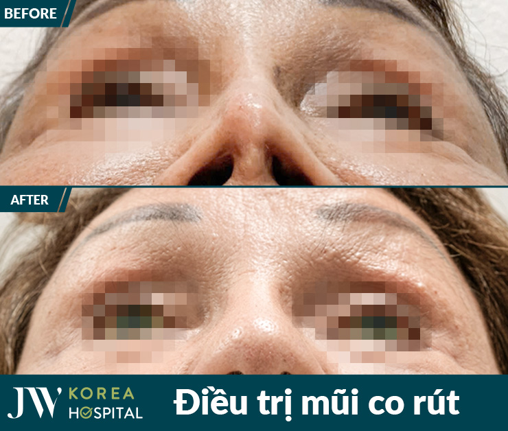 Bệnh viện JW đã tiếp nhận và điều trị thành công nhiều bệnh nhân bị biến chứng sau nâng mũi