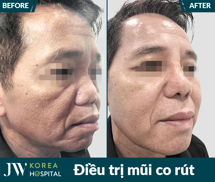 Bệnh nhân bị mũi co rút, biến dạng nặng do nâng mũi lỗi được bệnh viện JW và bác sĩ Tú Dung điều trị thành công