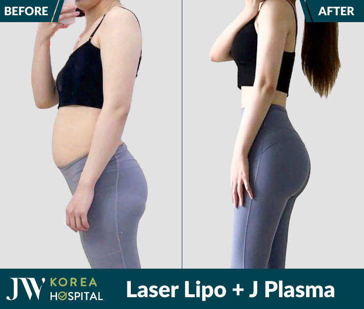 Giảm mỡ không phẫu thuật với Laser Lipo và J Plasma tại bệnh viện JW