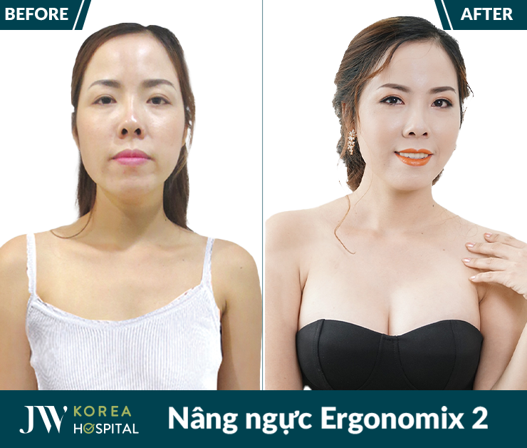 Vòng 1 hài hòa, cân đối hơn nhờ Nâng ngực Ergonomix 2 tại bệnh viện JW