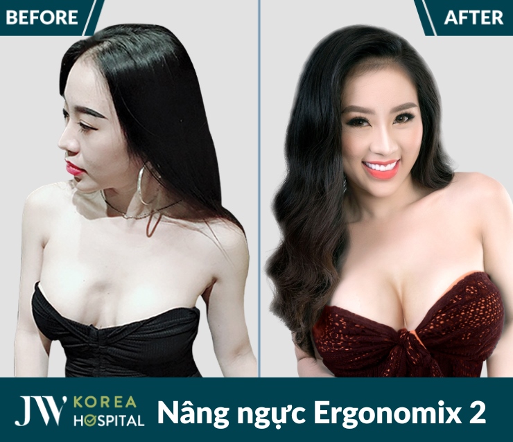 Đẹp tự tin, dáng chuẩn hơn với Nâng ngực Ergonomix 2 tại bệnh viện JW