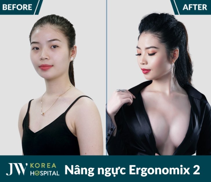 Vòng 1 căng đầy sức sống với Nâng ngực Ergonomix 2 tại bệnh viện JW