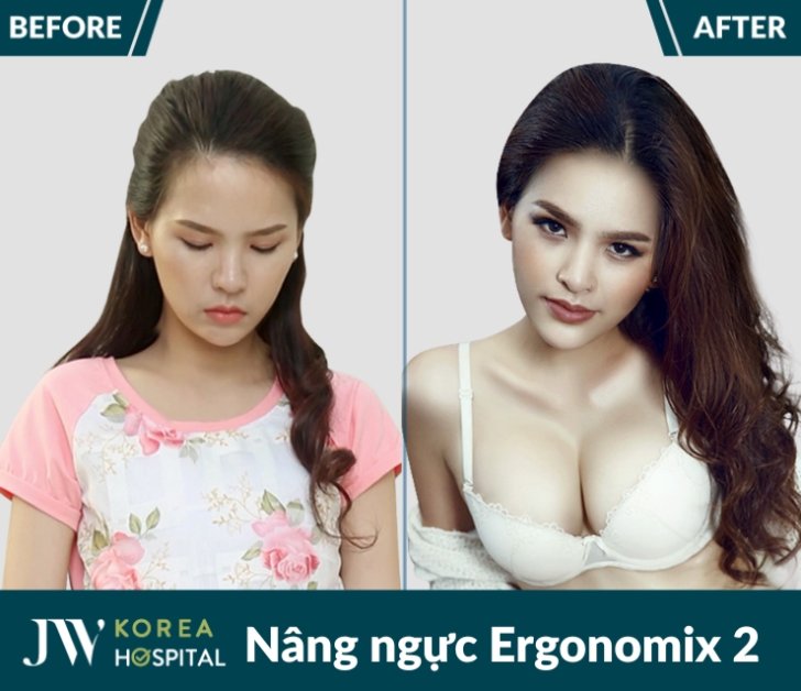 Vòng 1 mềm mại, linh hoạt theo từng chuyển động nhờ Nâng ngực Ergonomix 2 tại bệnh viện JW