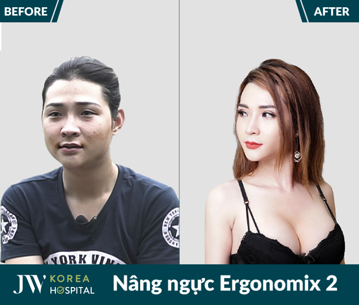Sở hữu đường cong cuốn hút nhờ Nâng ngực Ergonomix 2 tại bệnh viện JW