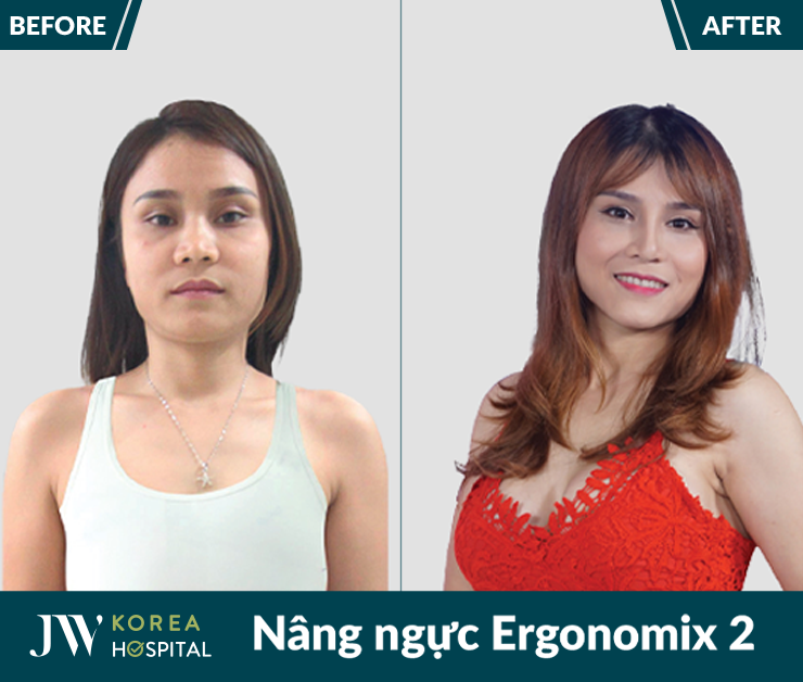Nâng ngực Ergonomix 2 tại bệnh viện JW giúp sở hữu vòng 1 căng tròn, mềm mại tự nhiên
