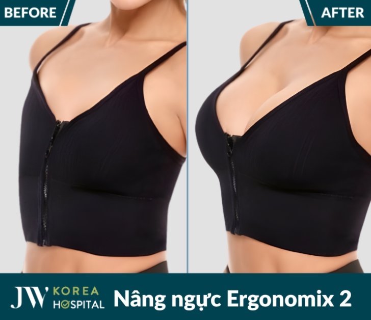 Nâng cấp vòng 1 tự nhiên, mềm mại với Nâng ngực Ergonomix 2 tại bệnh viện JW