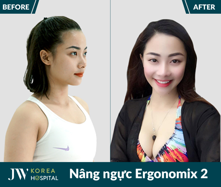Sở hữu vòng 1 quyến rũ căng tròn sau nâng ngực Ergonomix 2 tại Bệnh viện JW