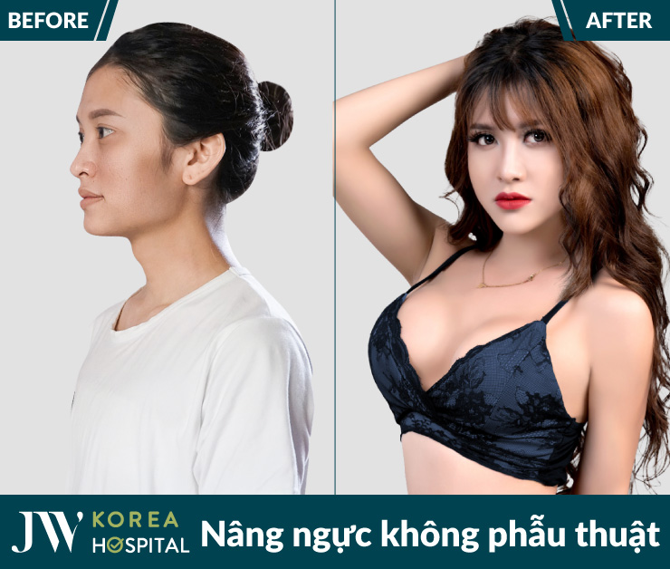 Kết quả trước và sau nâng ngực không phẫu thuật tại bệnh viện JW