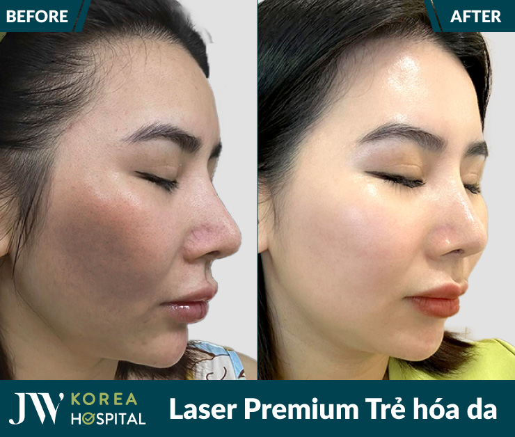 Laser Premium trẻ hóa da giúp xóa sạch vết nám, da sáng mịn, đày sức sống
