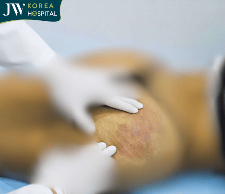 Vòng 3 của bệnh nhân sưng tấy, rỉ dịch sau nâng mông tại 1 cơ sở thẩm mỹ chui