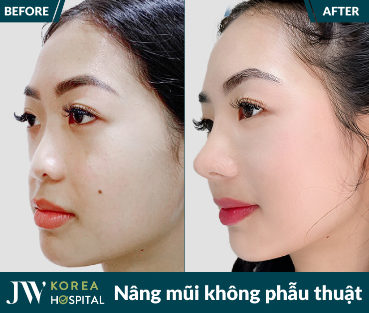 Nâng mũi không phẫu thuật bằng mỡ tự thân tại Bệnh viện JW giúp sở hữu dáng mũi cao sang cuốn hút