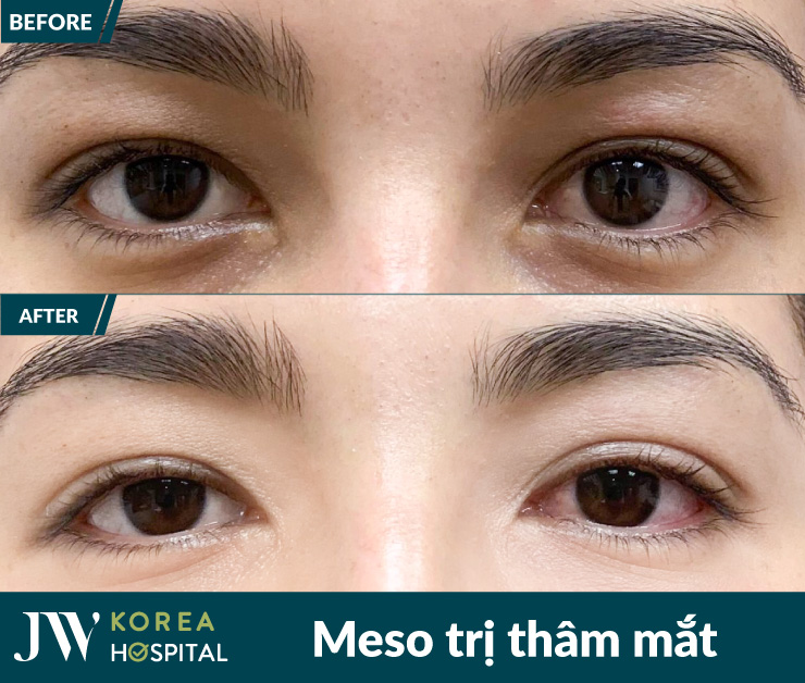 Trị dứt điểm quầng thâm mắt chỉ sau 1 liệu trình Meso tại Bệnh viện JW