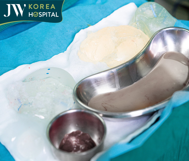 Túi độn vỡ nát và hơn 1 lít dịch mủ được lấy ra từ mông của bệnh nhân