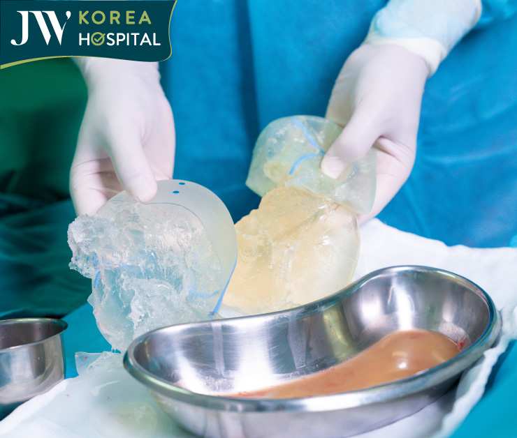 Hình ảnh túi độn mông vỡ nát và hơn 1 lít dịch mủ được ê-kíp bác sĩ Bệnh viện JW lấy ra