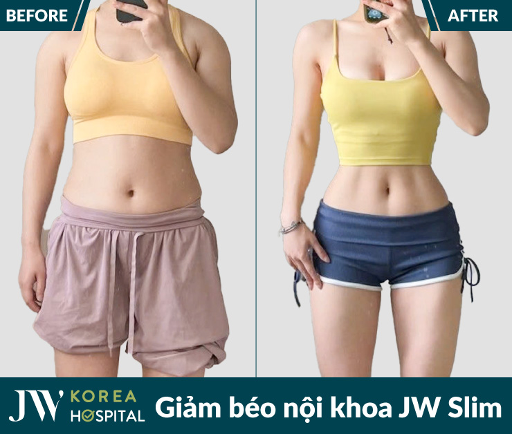 Xóa mỡ thừa, vóc dáng thon gọn chỉ sau 1 liệu trình JW Slim
