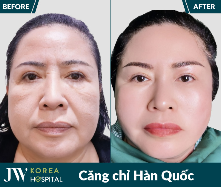 Xóa nếp nhăn, trẻ 20 tuổi không phẫu thuật với Căng chỉ Hàn Quốc tại Bệnh viện JW