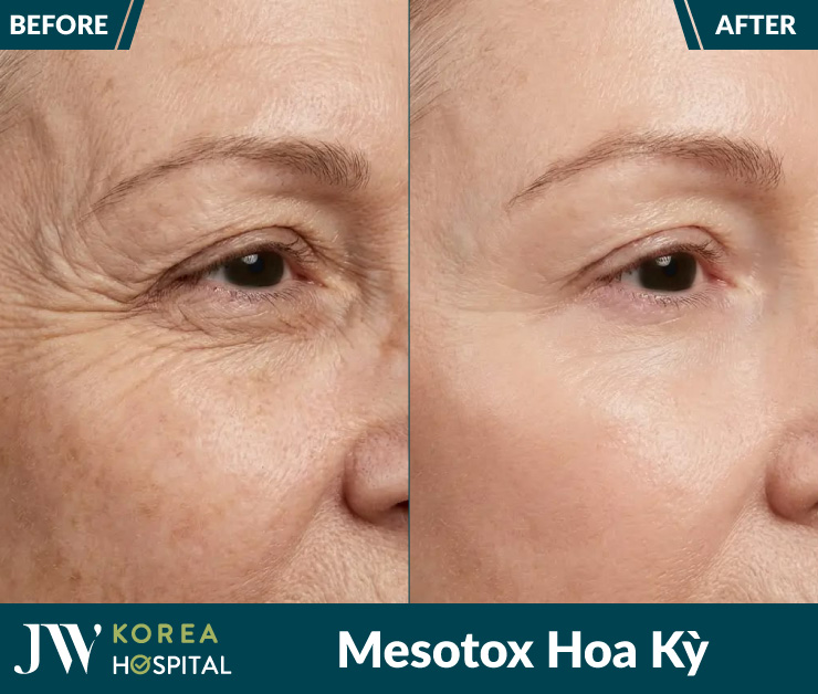 Xóa nếp nhăn trán, rãnh cười hiệu quả với Mesotox chuẩn Hoa Kỳ tại bệnh viện JW